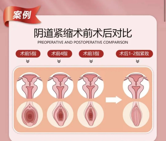 21035595.png 陰道松弛自測(cè).png