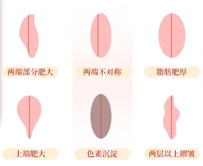 76189845.jpg 小陰唇.jpg