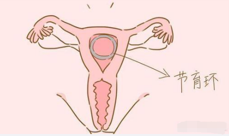 節育環.png